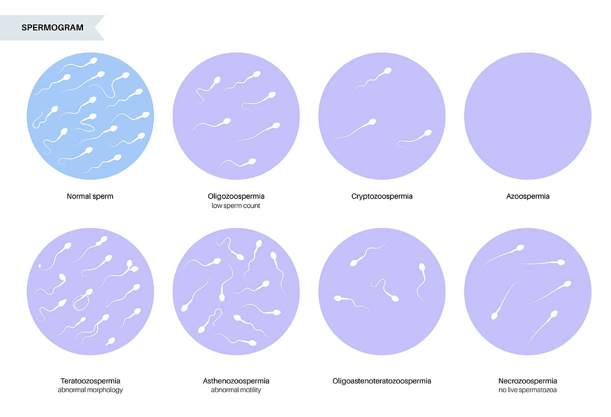 Spermogram (semen analizi) örnek sonuç ve parametrelerin değerlendirilmesi